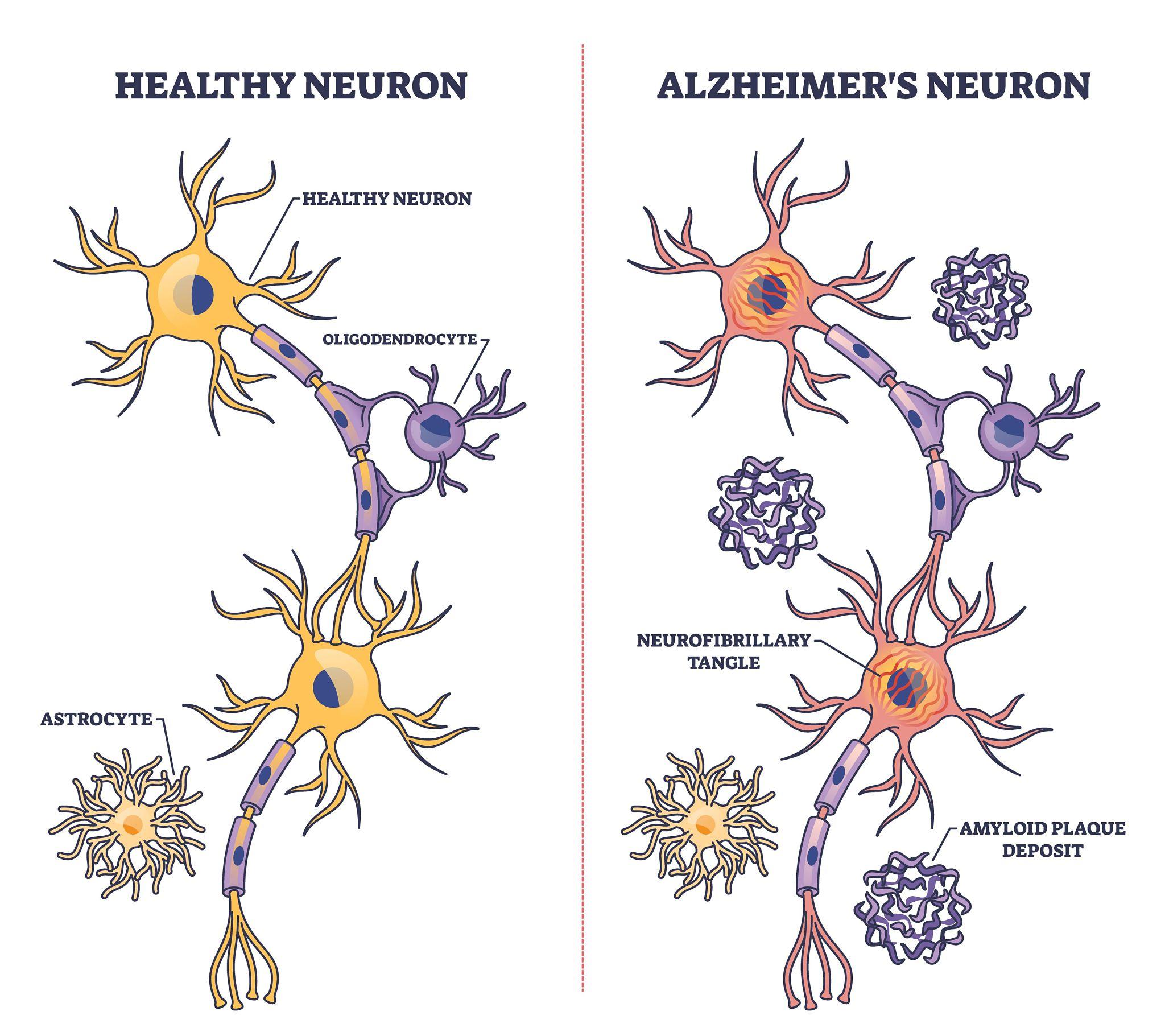 Alzheimer’s Disease